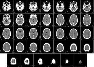 34 pictures of a brain. The last 6 show the brain decreasing in size.