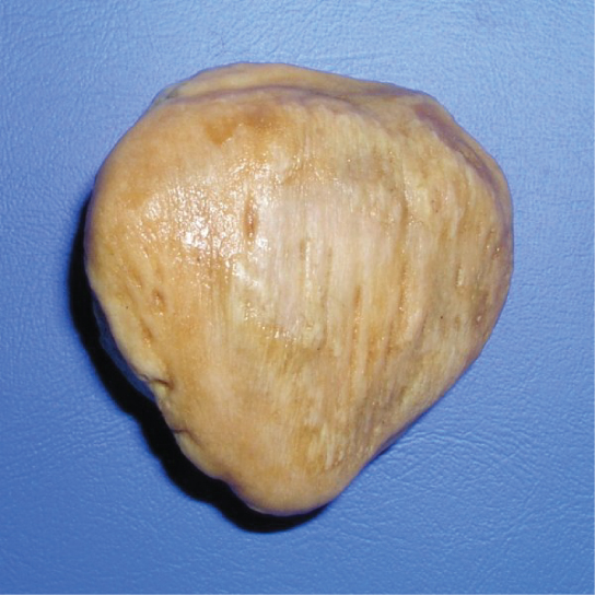 Figure 38.18. The patella of the knee is an example of a sesamoid bone.