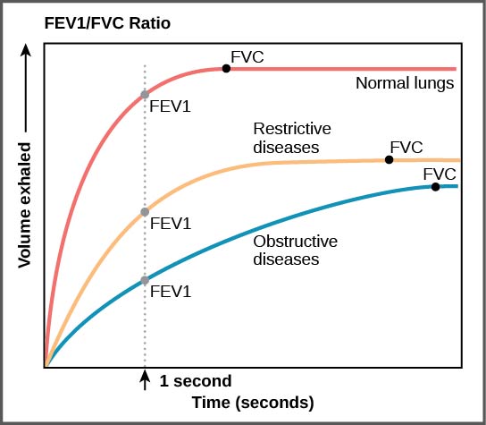 Figure 39.18. The ratio of FEV1 (the amount of air that can be forcibly exhaled in one second after taking a deep breath) to FVC (the total amount of air that can be forcibly exhaled) can be used to diagnose whether a person has restrictive or obstructive lung disease. In restrictive lung disease, FVC is reduced but airways are not obstructed, so the person is able to expel air reasonably fast. In obstructive lung disease, airway obstruction results in slow exhalation as well as reduced FVC. Thus, the FEV1/FVC ratio is lower in persons with obstructive lung disease (less than 69 percent) than in persons with restrictive disease (88 to 90 percent).