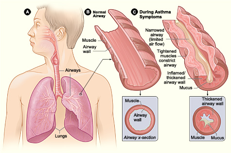 Figure A shows the location of the lungs and airways in the body. Figure B shows a cross-section of a normal airway.  Figure C shows a cross-section of an airway during asthma symptoms.