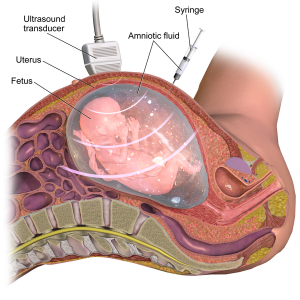 Amniocentesis.