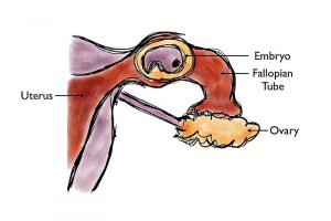 An ectopic pregnancy.