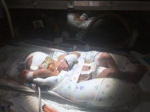 An infant receiving treatment for jaundice.