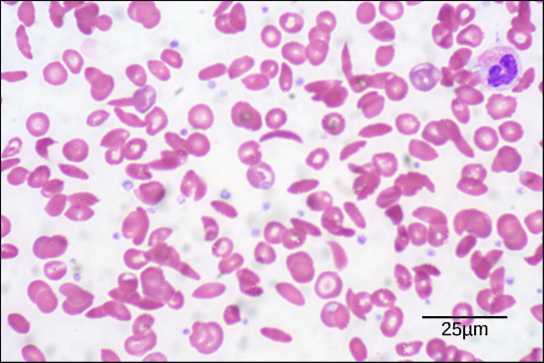 Figure 39.21. Individuals with sickle cell anemia have crescent-shaped red blood cells. (credit: modification of work by Ed Uthman; scale-bar data from Matt Russell)