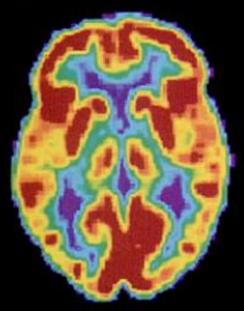A brain scan shows different parts of the brain in different colours.