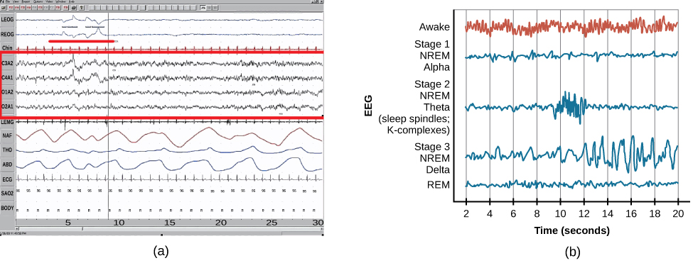 Chart A is a polysonograph with the period of rapid eye movement (REM) highlighted. Chart b shows brainwaves at various stages of sleep, with the “awake” stage highlighted to show its similarity to the wave pattern of “REM” in chart A.