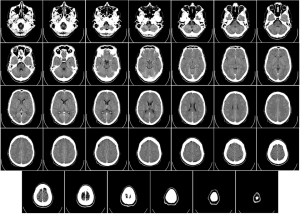 Series of axial CT scan slices of a human brain, displayed in a grid layout. The images progress from the base of the skull at the top row through higher sections of the brain in subsequent rows, ending with small circular cross-sections near the top of the skull in the bottom row. Each slice shows varying anatomical structures including bone, ventricles, and brain tissue.